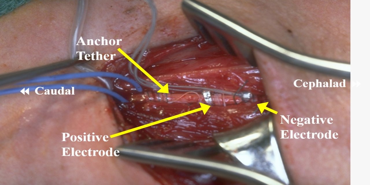 Epilepside İlaç Dışı Tedavi: Vagal Sinir Stimülasyonu Nedir, Nasıl Uygulanır?